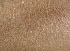 peau eczema