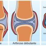 arthrose